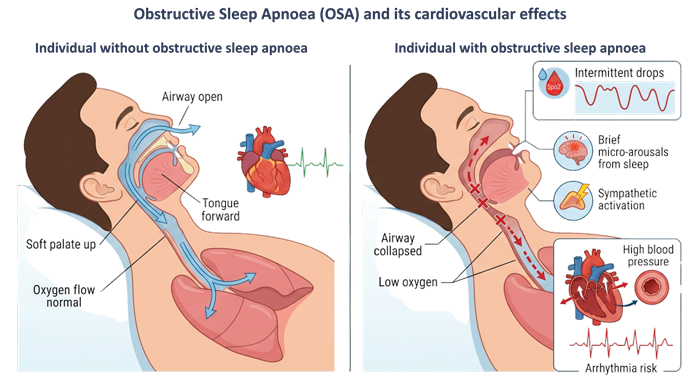 The Hidden Link Between Sleep Apnoea And Heart Health The Hidden Link Between Sleep Apnoea And Heart Health