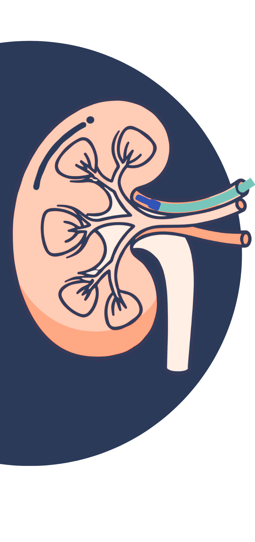 When Your Blood Pressure Won't Budge: Could Renal Denervation Be The Answer? When Your Blood Pressure Won't Budge: Could Renal Denervation Be The Answer?
